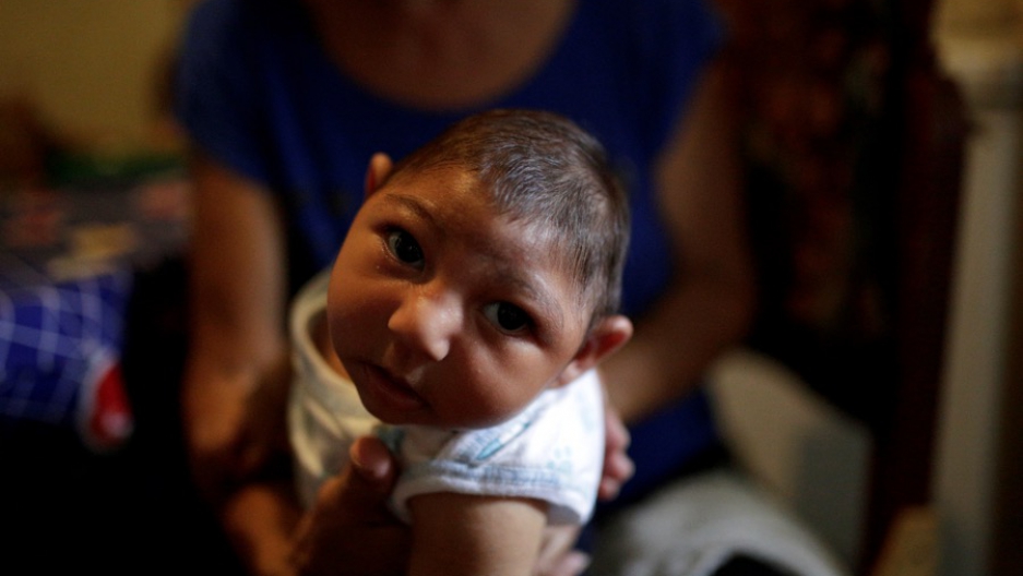 Three-month-old Jesus, photographed on Oct. 5 in Guarenas, Venezuela, was born with microcephaly